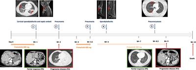 A double-edged sword: unusual multiple severe infections with pralsetinib: a case report and literature review